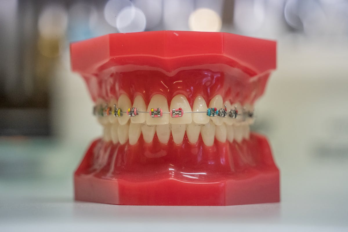 Ceramic brackets dental model
